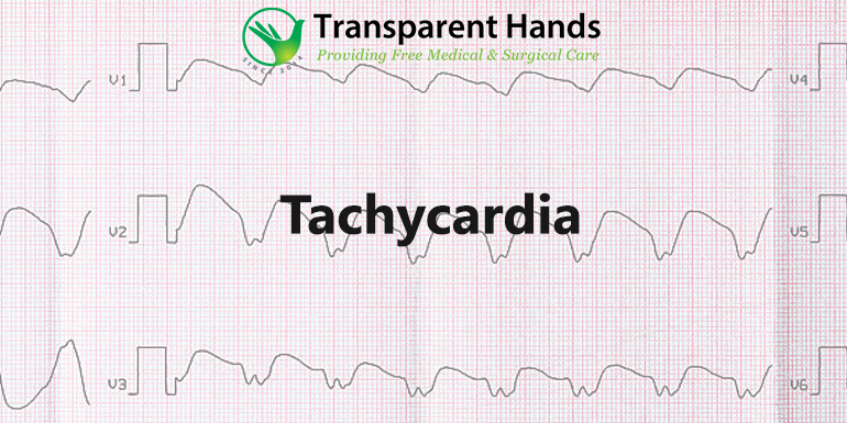 tachycardia
