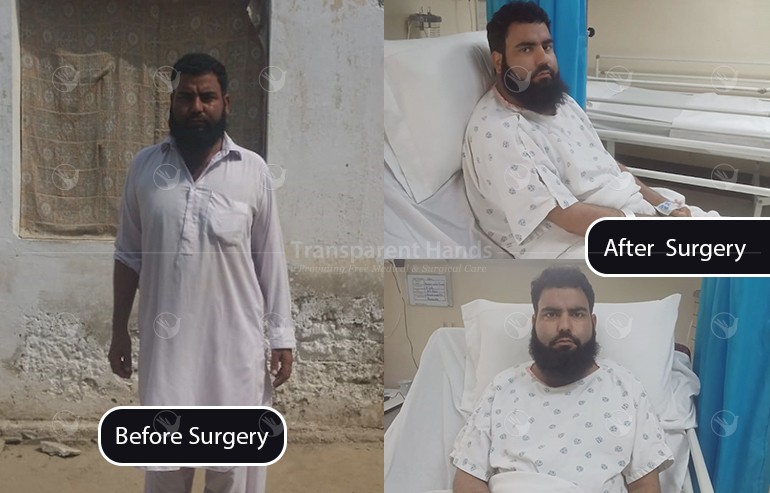 bade uz zaman Hip Replacement