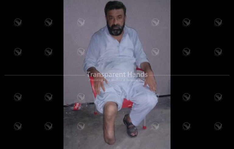 mohsin javed Artificial Leg patient pre image